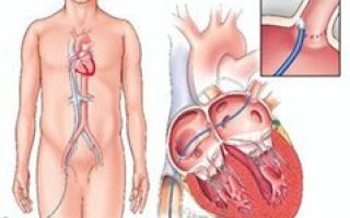 Абляция (РЧА сердца): что это такое, показания и противопоказания к операции, как ее делают, реабилитация и возможные осложнения