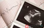 Ктг (кардиотокография) плода при беременности: понятие, норма, ход процедуры, расшифровка и интерпретация