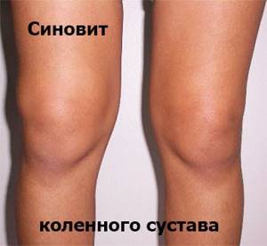 Синовит коленного сустава: классификация и формы заболевания, способы лечения, прогноз и профилактика