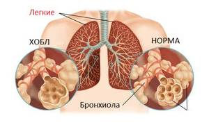 ХОБЛ (хроническая обструктивная болезнь легких): классификация и причины развития, симптоматика и варианты лечения