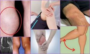Киста Бейкера коленного сустава: причины возникновения, характерные симптомы, диагностика и способы лечения