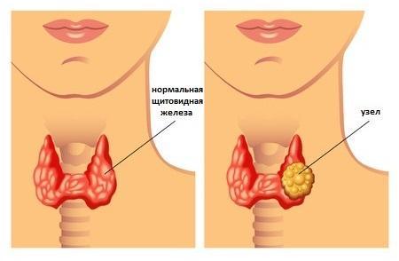 Аутоиммунный тиреоидит щитовидной железы: причины заболевания, стадии развития, симптомы и методы лечения