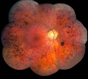 Абиотрофия сетчатки глаза: классификация и причины развития патологии, клиническая картина и методы диагностики, способы лечения и возможные осложнения, прогноз на выздоровление