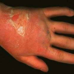 Лечение аллергического дерматита у взрослых: описание и причины появления заболевания, характерные симптомы и правила профилактики, разновидности патологии и рекомендации по питанию