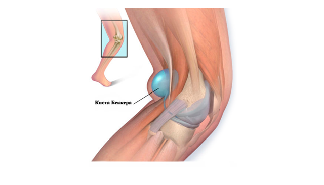 Как эффективно лечить бурсит коленного сустава: народные рецепты и медикаментозная терапия, показания для проведения операции и возможные последствия