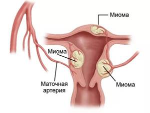 Первые признаки миомы матки: провоцирующие факторы, сопутствующие симптомы, способы лечения и профилактические меры