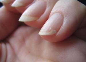 Что делать, если слоятся ногти на руках: причины расслоения ногтевой пластины, популярные салонные процедуры и эффективные способы лечения в домашних условиях, основные правила профилактики