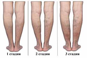Варикозное расширение вен на ногах: причины появления и первые признаки патологии, разновидности заболевания и стадии развития, методы диагностики и варианты лечения, возможные осложнения