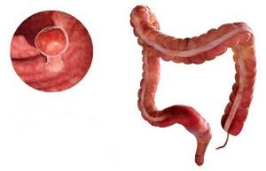 Полипы в кишечнике: происхождение и классификация новообразований, характерные проявления, способы лечения и особенности диеты