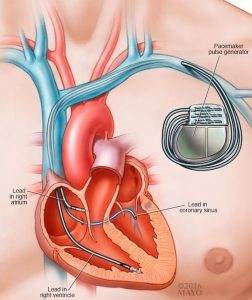 Мерцательная аритмия сердца: что это такое, распространенность и возможные осложнения, способы лечения
