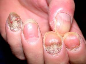 Лечение псориаза ногтей медикаментозными и народными средствами