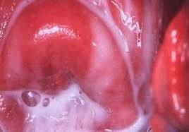 Бактериальный вагиноз: провоцирующие факторы и основные причины заболевания, первые признаки и характерные симптомы, схема лечения патологии и возможные осложнения