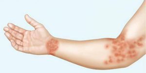 Лечение контактного дерматита: признаки и виды высыпаний на разных стадиях болезни, причины возникновения и особенности течения заболевания у взрослых и детей