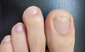Грибок ногтей на руках: первые признаки и симптомы развития заболевания, современная диагностика и лечение болезни