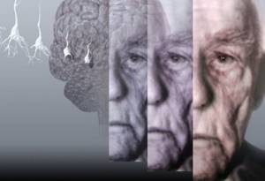 Деменция: описание патологии, причины возникновения и классификация заболевания, стадии развития и прогноз продолжительности жизни при последней стадии слабоумия