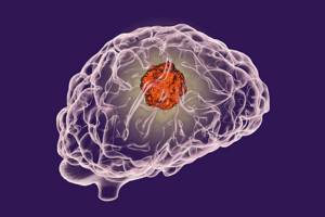 Астроцитома головного мозга: причины заболевания и его лечение, прогноз для жизни, методы профилактики