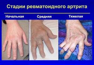 Схема лечения артрита пальцев рук: признаки и виды заболевания, диагностика и профилактика болезни