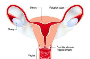 Как лечить вагинальный кандидоз: симптомы и методы терапии, опасность заболевания для беременных и меры профилактики