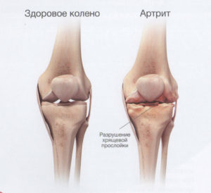 Первые симптомы артрита коленного сустава: степени и формы заболевания, основные признаки патологии, медикаментозная терапия и лечебные приспособления