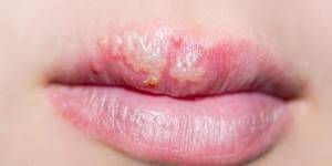 Как лечить герпес на губах: причины заболевания, применение противовирусных мазей и народных средств, отзывы пациентов