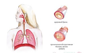 ХОБЛ (хроническая обструктивная болезнь легких): классификация и причины развития, симптоматика и варианты лечения
