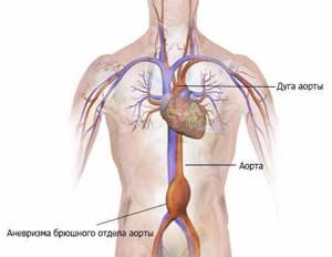 Лечение аневризмы аорты - действенные и распространенные методики