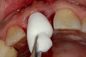 Альвеолит лунки после удаления зуба: причины и виды заболевания, характерные признаки, возможные осложнения и методы лечения
