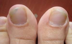 Как выглядит грибок ногтей на ногах: основная симптоматика, формы и стадии заболевания, народные методы и медикаментозное лечение