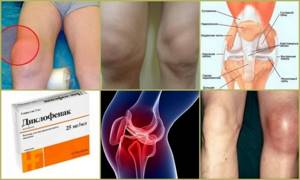 Киста Бейкера коленного сустава: причины возникновения, характерные симптомы, диагностика и способы лечения