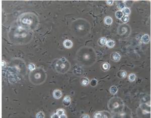 Лейкоциты в моче у женщин: пределы нормы, причины отклонений, правила подготовки к анализу
