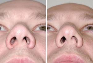Полипы в носу: причины возникновения, сопутствующие симптомы, хирургические и народные способы лечения