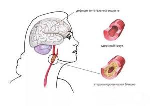 Атеросклероз сосудов головного мозга: разновидности патологии, причины развития и симптомы заболевания, эффективные методы лечения и профилактики