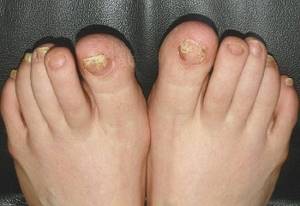 Чем лечить грибок ногтей на ногах в домашних условиях: действенные лекарственные препараты и народные средства, советы врачей