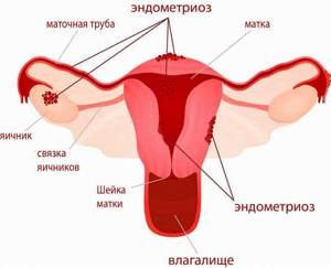 Эндометриоз матки: классификация патологии и ее формы, причины и механизм развития болезни, лечебно-диагностические мероприятия, возможные осложнения и прогноз на выздоровление