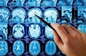 Астроцитома головного мозга: причины заболевания и его лечение, прогноз для жизни, методы профилактики