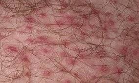 Вросший волос в области бикини, на ногах: причины вростания, как избавиться в домашних условиях и предотвратить образование шишек, когда обращаться к врачу