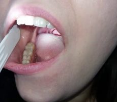 Кандидоз полости рта: причины заболевания, сопутствующие признаки и методы лечения