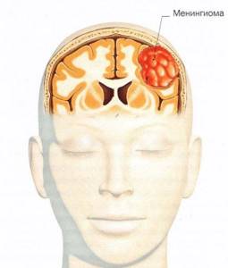 Менингиома головного мозга: классификация и локализация опухоли, клинические проявления, диагностика и способы лечения