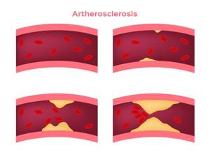 Облитерирующий атеросклероз сосудов нижних конечностей: причины болезни, характерные признаки, методы лечения