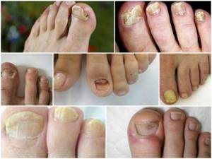Как выглядит грибок ногтей на ногах: основная симптоматика, формы и стадии заболевания, народные методы и медикаментозное лечение