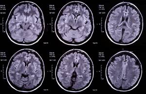 Абсцесс головного мозга: причины возникновения, сопутствующие симптомы, диагностика и лечение