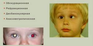 Амблиопия глаза: причины развития и признаки патологии, программы для лечения и прогноз
