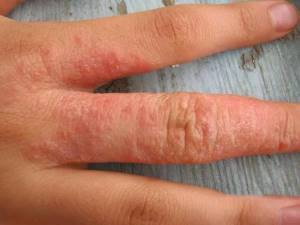 Аллергия на холод, или причина болезни - зима