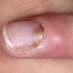Панариций пальца на руке: причины и симптомы заболевания, лечение препаратами и народными способами
