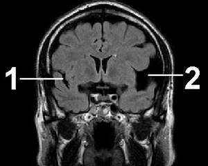 Арахноидит головного мозга: виды и характерные признаки, возможные последствия, методы лечения