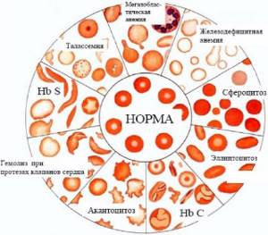Железодефицитная анемия: причины развития и проявления заболевания, методы терапии и правила питания