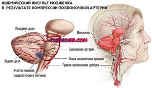 Синдром позвоночной артерии: природа появления, сопутствующие симптомы, способы лечения и профилактика