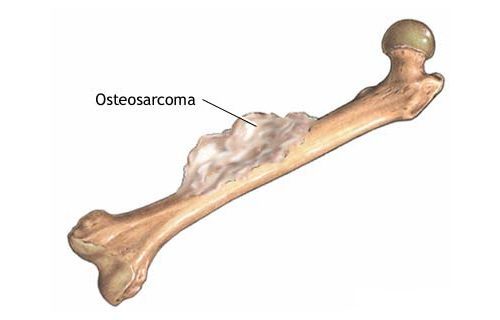 Остеосаркома: причины возникновения опухоли, характерные признаки, способы лечения