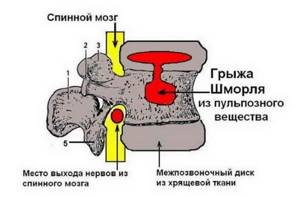 Грыжа Шморля: причины возникновения и признаки развития заболевания, профилактика и методы лечения патологии, советы специалистов