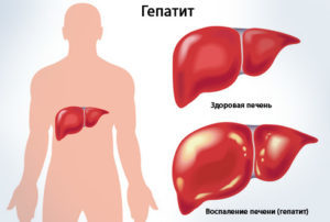 Гепатит В: что это такое, формы и признаки развития заболевания, варианты лечения и вакцинация в России